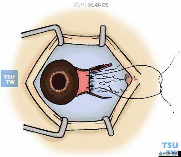 获得超级胬肉系统怎么办：探寻解决之法